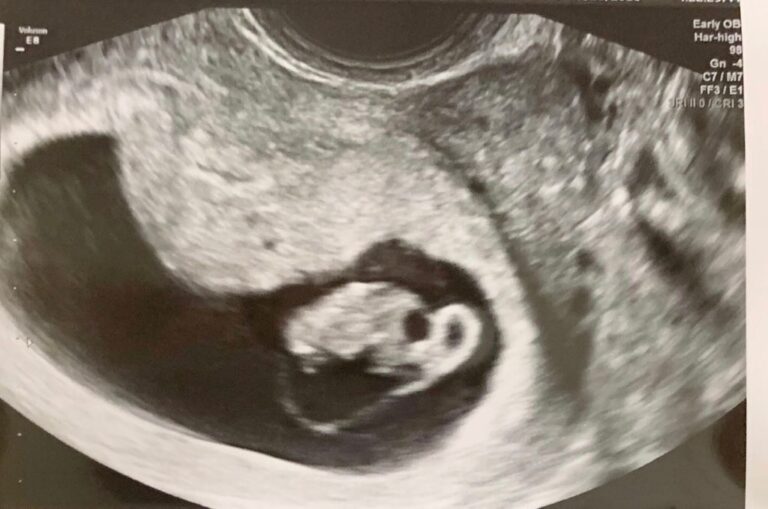 شكل كيس الحمل بعد الإجهاض في الشهر الثاني